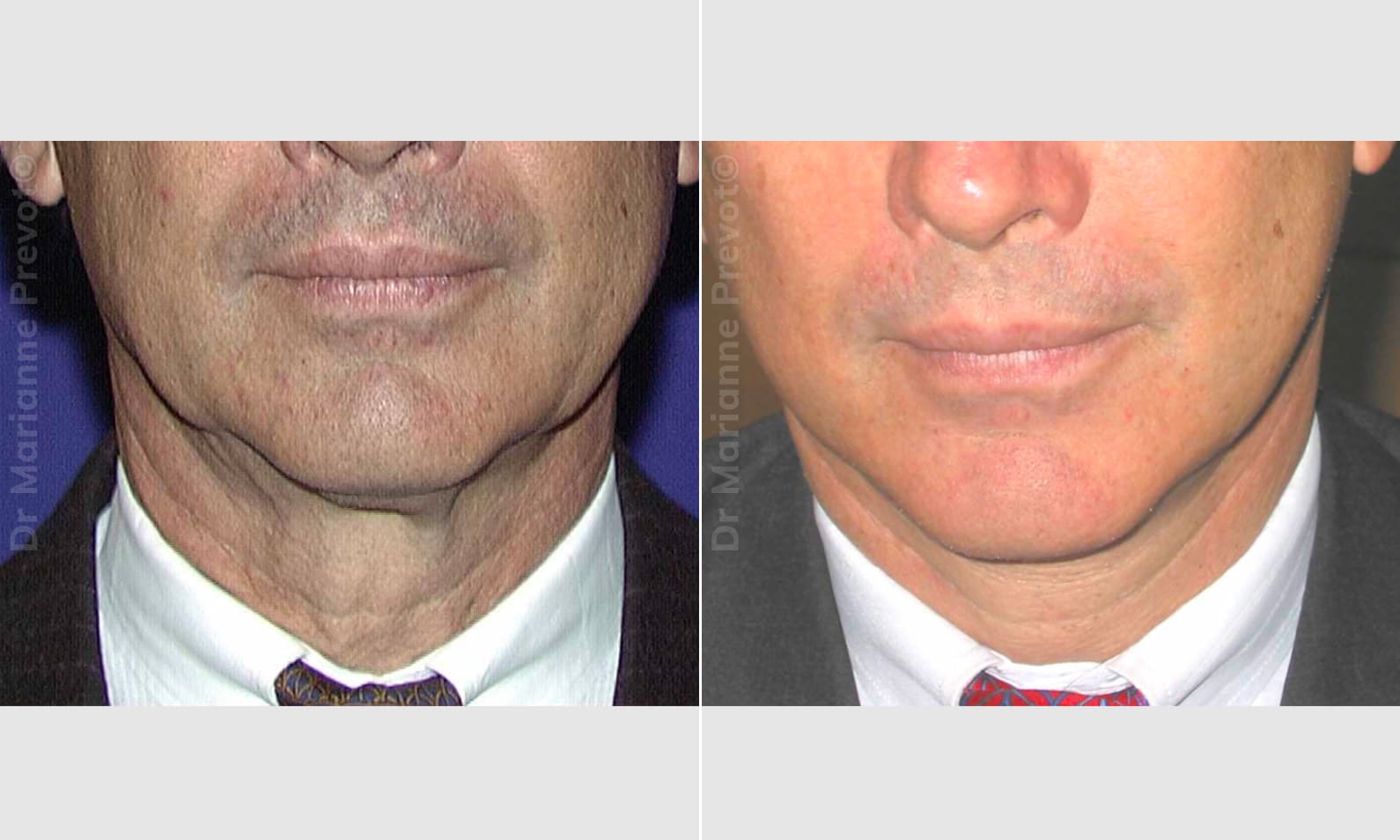 Micro Lift in Geneva - Dr. Prevot, Cosmetic and Reconstructive Surgery