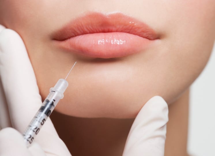 Injection acide hyaluronique lèvres